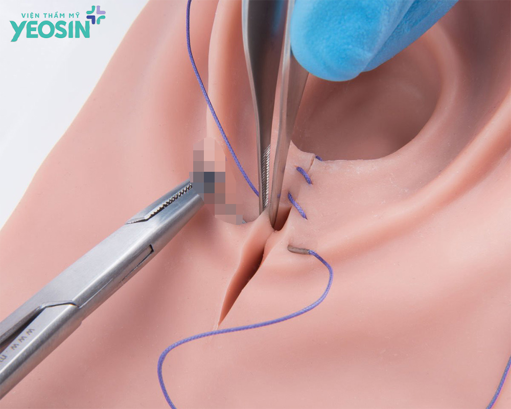 Tái tạo tầng sinh môn sau sinh 5 Tại sao nên chọn tái tạo thẩm mỹ tầng sinh môn sau sinh