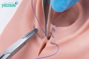 tái tạo thẩm mỹ tầng sinh môn sau sinh