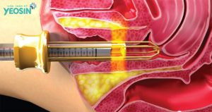 Trẻ hóa âm đạo