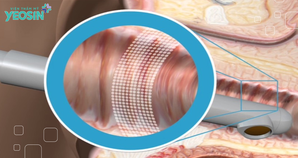 Cơ chế hoạt động của công nghệ vi điểm làm trẻ hóa âm đạo