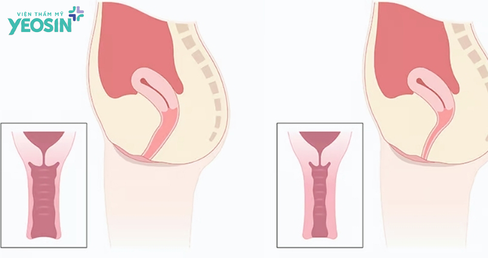 Hiệu quả nhận được sau khi vi điểm làm trẻ hóa âm đạo