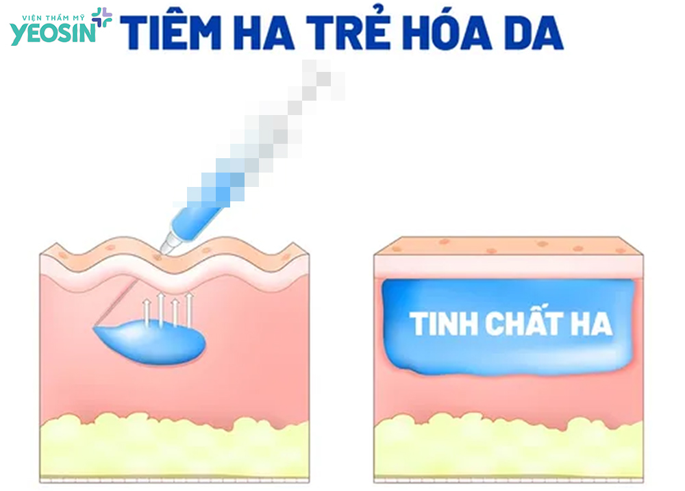 Trẻ hóa da bằng tạo hình HA Filler 6 Hiệu quả nhận được sau khi trẻ hóa da bằng HA
