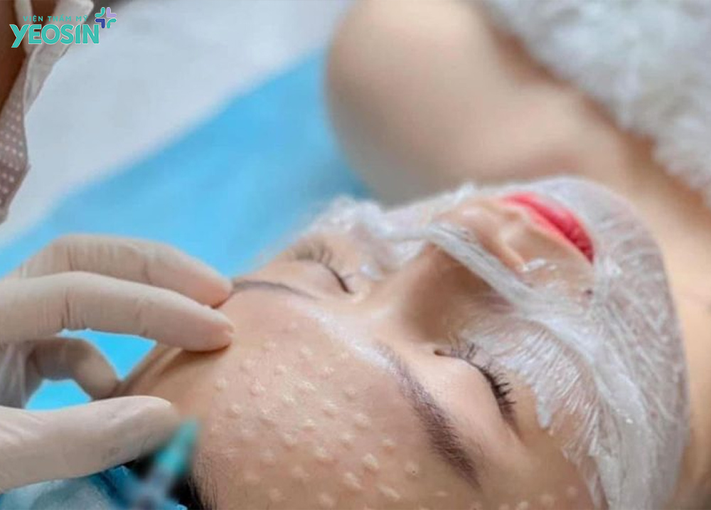 Trẻ hóa da bằng tạo hình HA Filler 10 Quy trình trẻ hóa da bằng tạo hình HA