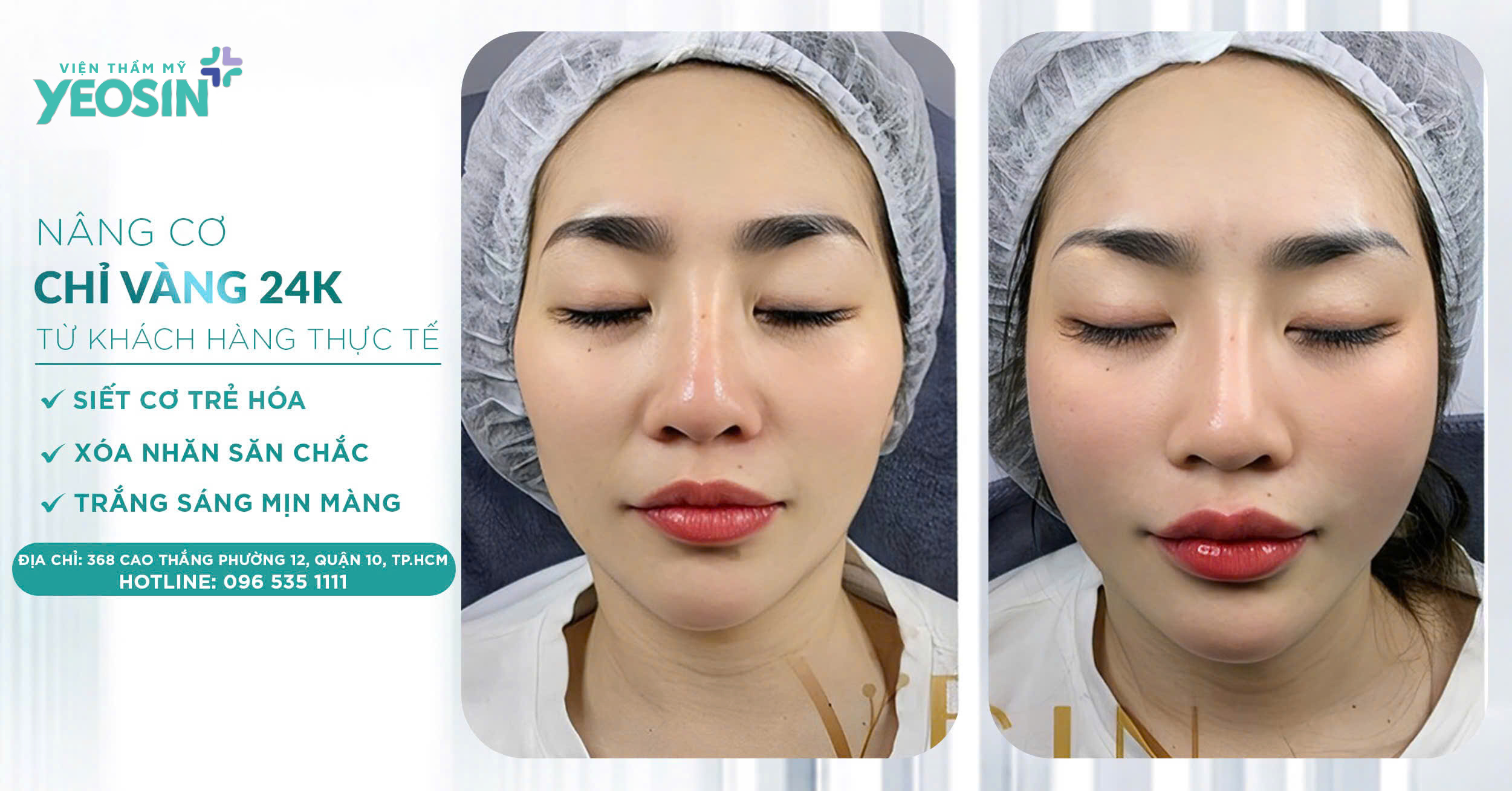 Nâng cơ trẻ hóa Hifu Doublo 2025 - Chìa khóa giữ mãi nét xuân 35 z6532626272295 967bc22f9ea052a538290de1795effdf 1