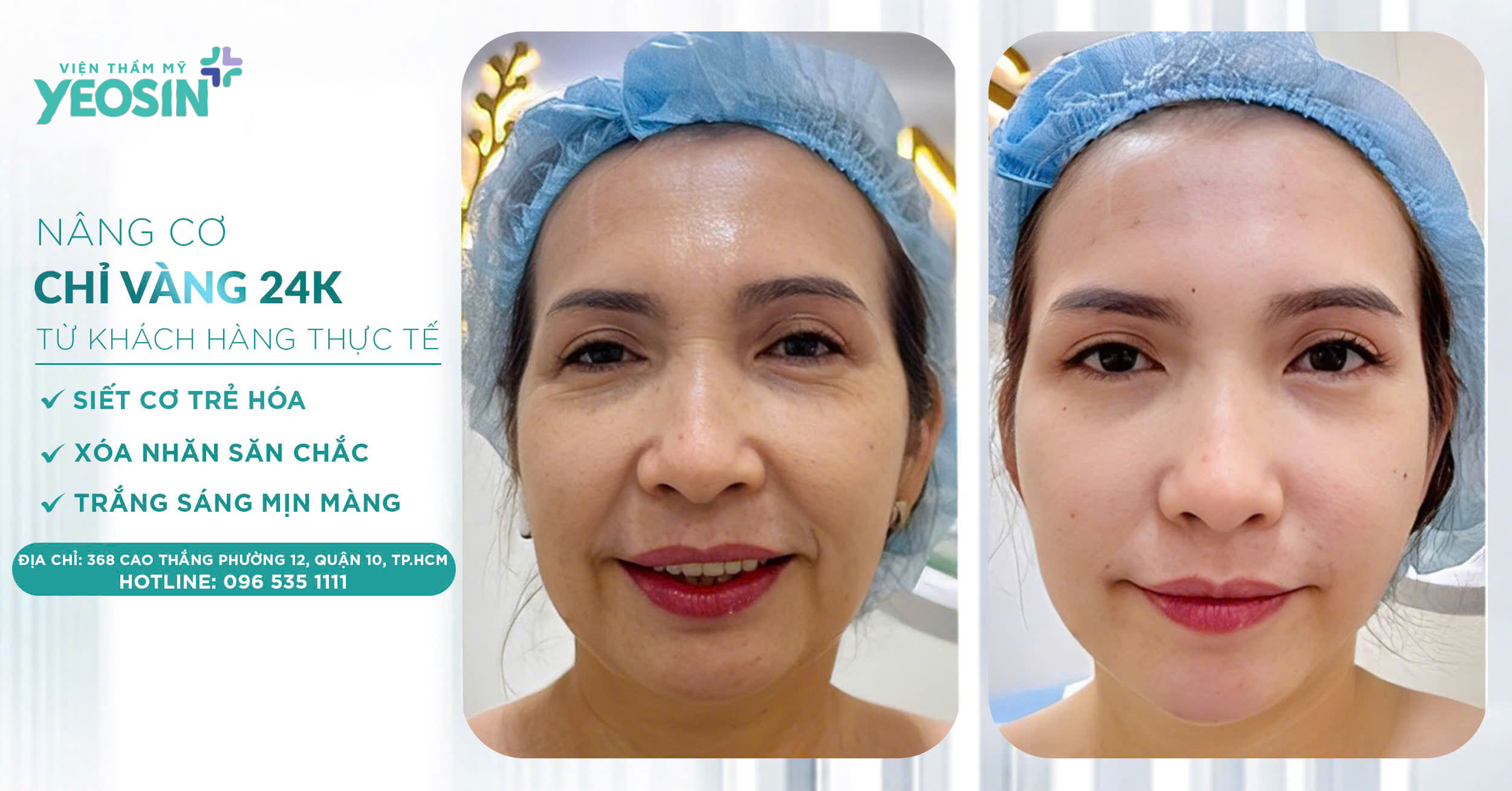 Nâng cơ trẻ hóa Hifu Doublo 2025 - Chìa khóa giữ mãi nét xuân 36 z6532626324426 e8255db88782ff265d75c201b83fab1e 1