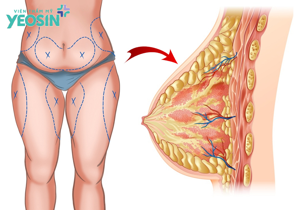 Nâng ngực bằng mỡ tự thân là gì?