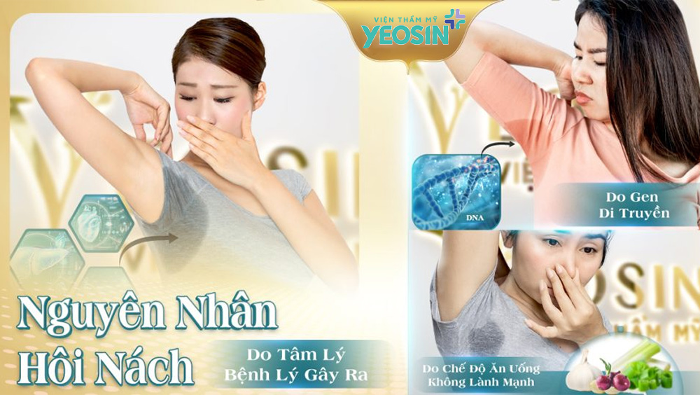 Bị hôi nách do nguyên nhân gì