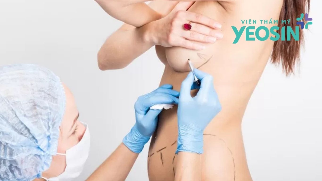 Nâng ngực không phẫu thuật tại Viện Thẩm Mỹ YeosinNâng ngực không phẫu thuật tại Viện Thẩm Mỹ Yeosin