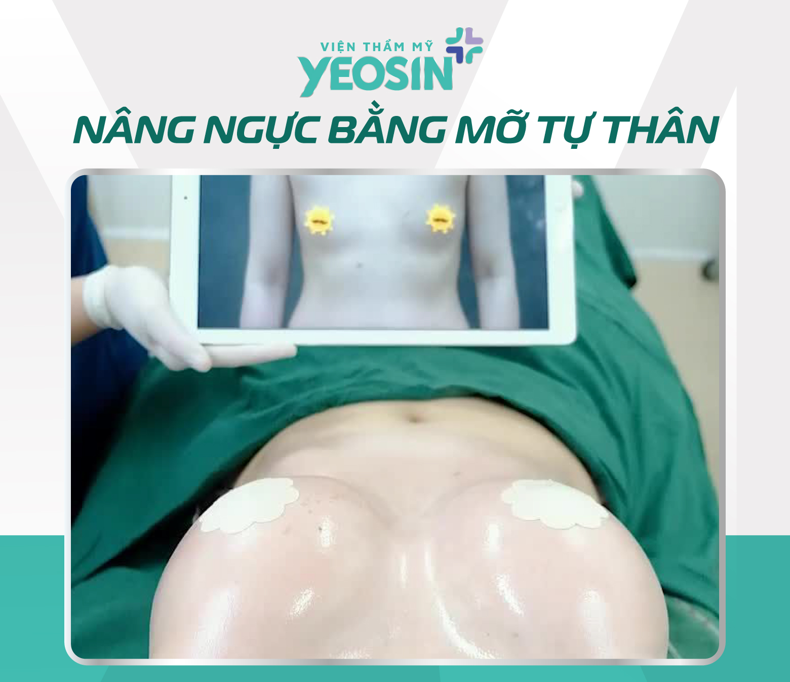 Kết quả nâng ngực bằng mỡ tự thân tại Yeosin