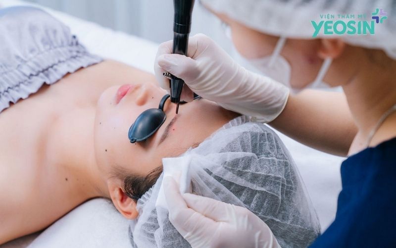 Tẩy Nốt Ruồi Bằng Công Nghệ Laser CO2: Sạch Chân, Không Sẹo, An Toàn Tuyệt Đối