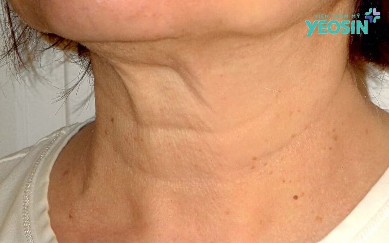 Căng Da Vùng Cổ: Lấy Lại Đường Viền Hàm Thanh Tú Và Chiếc Cổ Cao Kiêu Kỳ