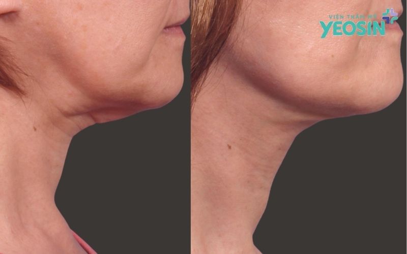 Căng Da Vùng Cổ: Lấy Lại Đường Viền Hàm Thanh Tú Và Chiếc Cổ Cao Kiêu Kỳ