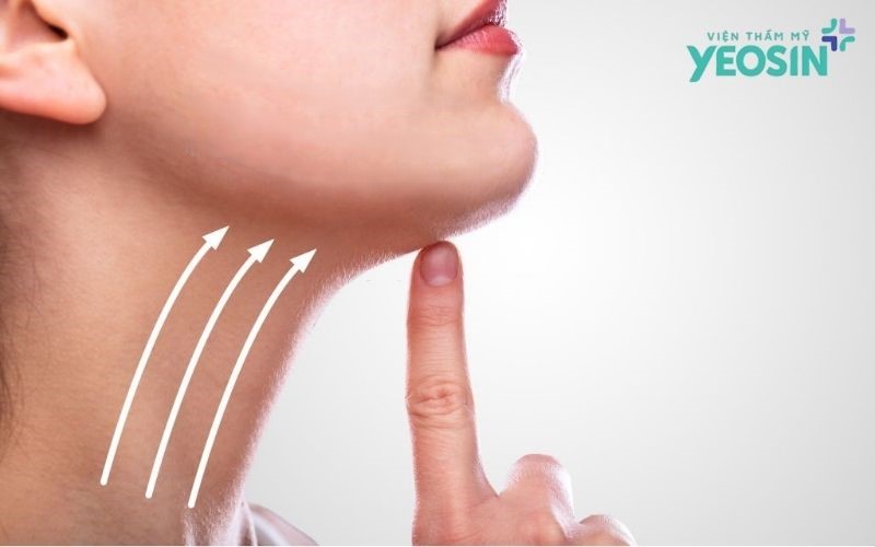 Căng Da Vùng Cổ: Lấy Lại Đường Viền Hàm Thanh Tú Và Chiếc Cổ Cao Kiêu Kỳ