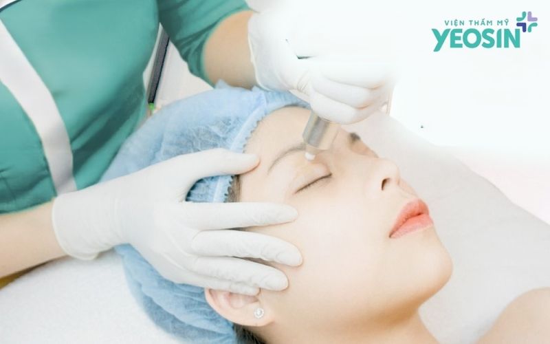 Nâng Cung Mày Có Phải Là Giải Pháp Cứu Cánh?