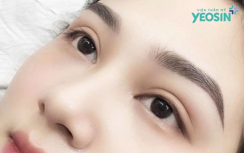 Nâng Cung Mày Có Phải Là Giải Pháp Cứu Cánh?