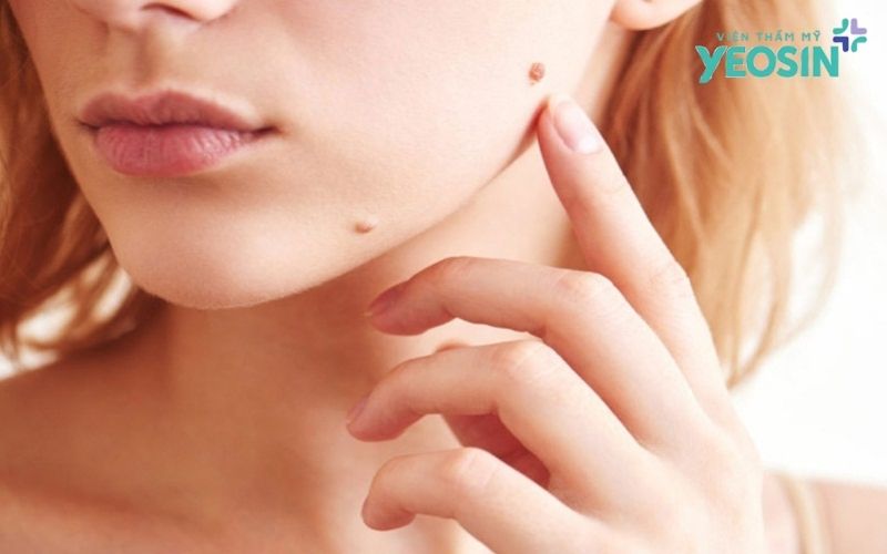 Tẩy Nốt Ruồi Bằng Công Nghệ Laser CO2: Sạch Chân, Không Sẹo, An Toàn Tuyệt Đối