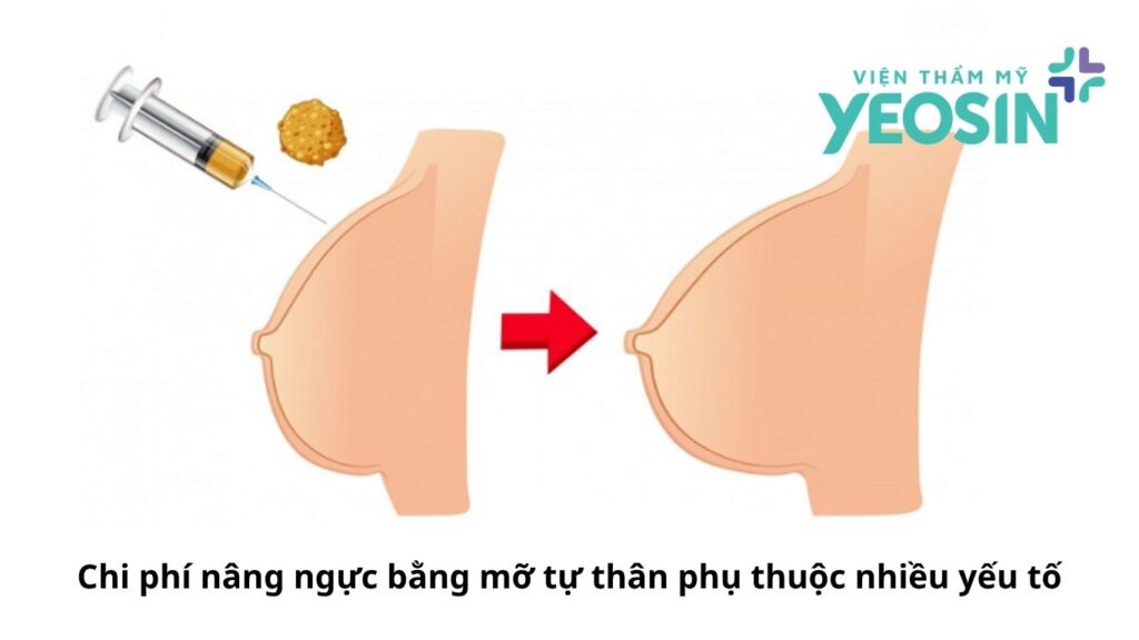 Nâng ngực cấy mỡ tự thân bao nhiêu tiền còn phụ thuộc vào nhiều yếu tố khác nhau. Nâng ngực cấy mỡ tự thân bao nhiêu tiền còn phụ thuộc vào nhiều yếu tố khác nhau.