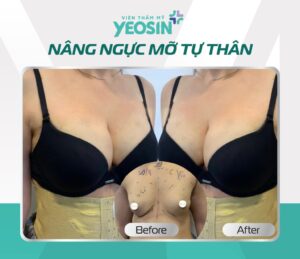 Kết quả nâng ngực bằng mỡ tự thân tại Yeosin