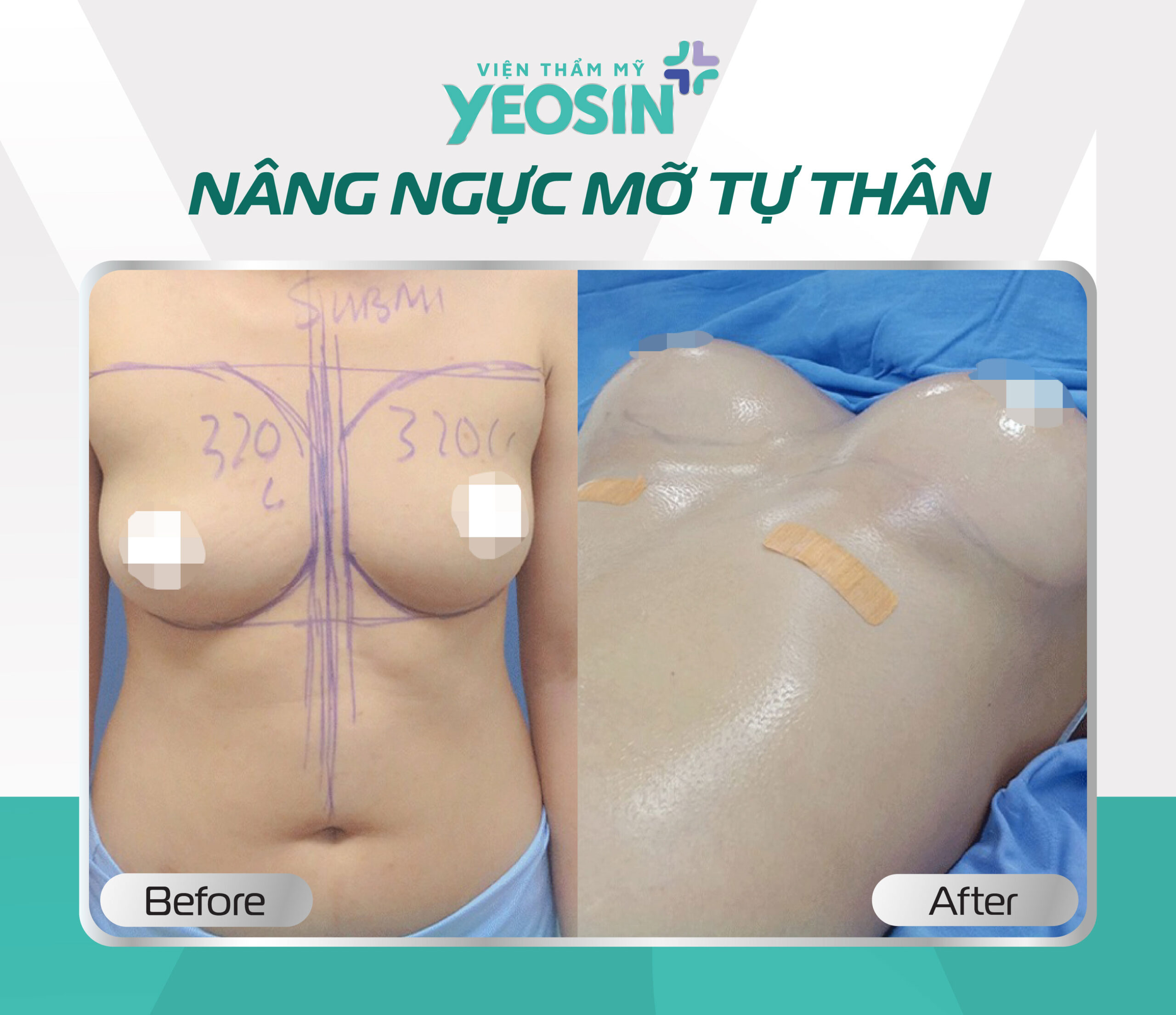 Kết quả trước - sau khi nâng ngực bằng mỡ tự thân