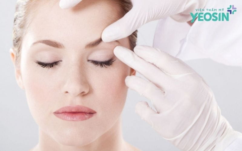 Nâng Cung Mày Có Phải Là Giải Pháp Cứu Cánh?