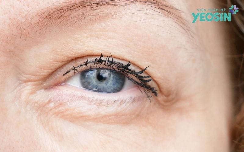 Nâng Cung Mày Có Phải Là Giải Pháp Cứu Cánh?