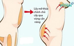 Nâng ngực cấy mỡ tự thân có quy trình đơn giản và ít xâm lấn