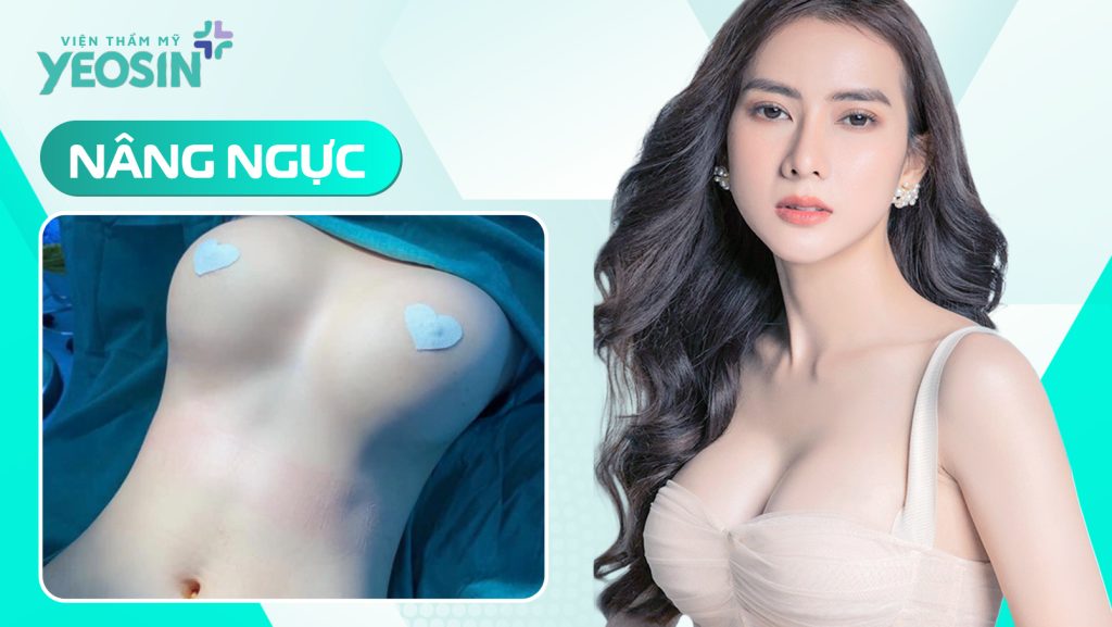 Nâng ngực cấy mỡ tự thân bao nhiêu tiền? Cập nhật chi phí mới nhất 2 Nâng ngực bằng mỡ tự thân tại Viện Thẩm Mỹ Yeosin: ĐẸP - AN TOÀN - TỐI ƯU CHI PHÍ.