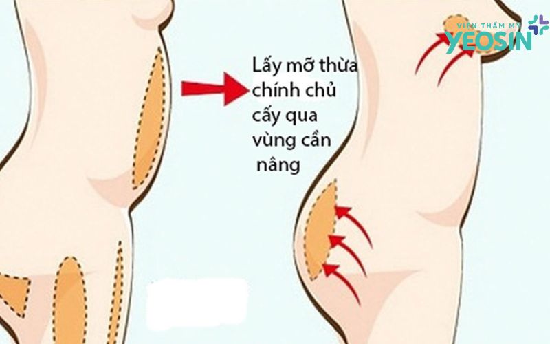 Nâng ngực bằng mỡ tự thân có tốt không: quy trình đơn giản và ít xâm lấn