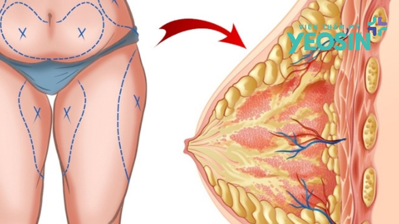 Nâng ngực không phẫu thuật là như thế nào Nâng ngực không phẫu thuật là như thế nào?