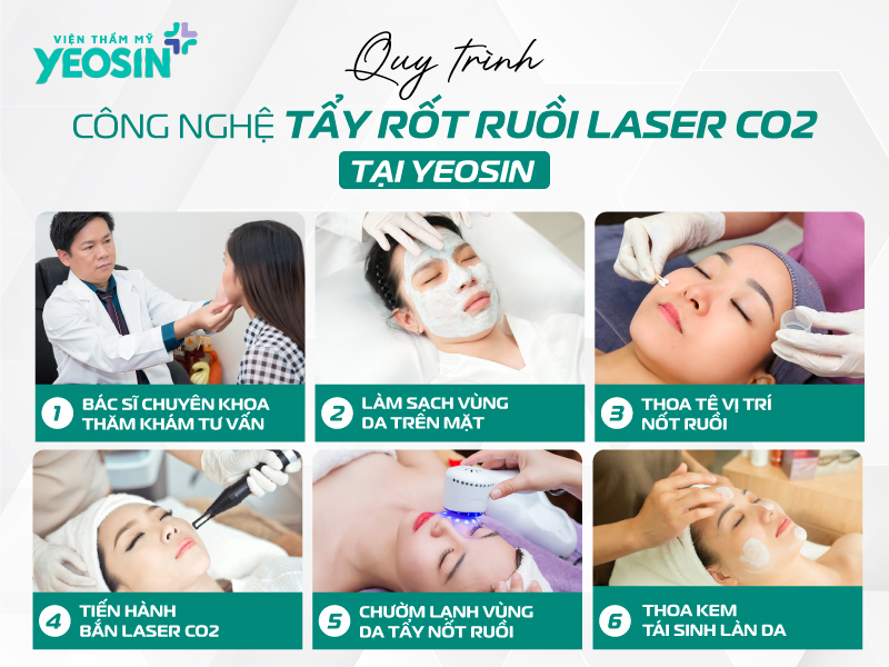 Quy trình xóa nốt ruồi bằng laser chuẩn y khoa có những bước nào?