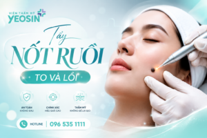 Tẩy nốt ruồi to và lồi