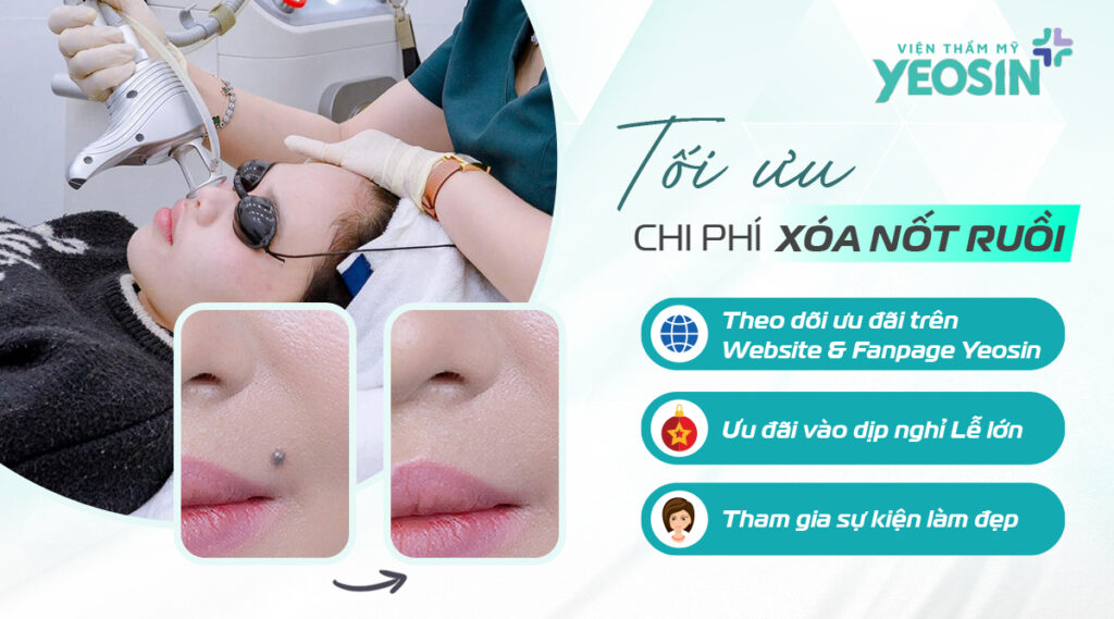 Cách tối ưu chi phí xóa nốt ruồi khi đến với Yeosin