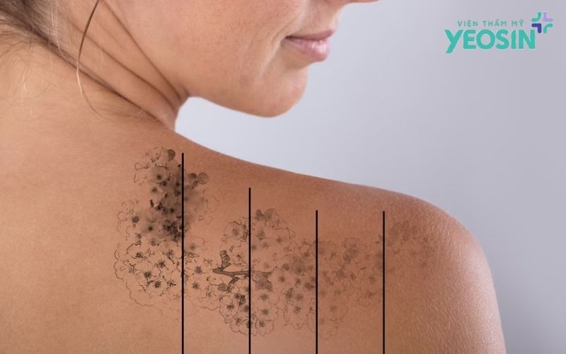 Xóa xăm có để lại sẹo không?