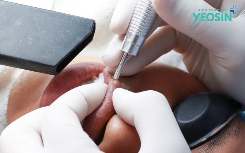 Đốt hạt Fordyce tại Yeosin - Giải pháp cải thiện đốm trắng trên môi bằng công nghệ Plasma 10 Đốt Hạt Fordyce Tại Yeosin Bằng Phương Pháp Gì?