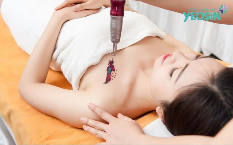 Xóa xăm bằng laser có hiệu quả không?