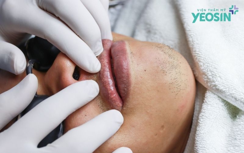Đốt hạt Fordyce tại Yeosin - Giải pháp cải thiện đốm trắng trên môi bằng công nghệ Plasma 9 Vì Sao Nhiều Người Muốn Đốt Hạt Fordyce?