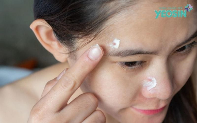 Phương Pháp Điều Trị Sẹo Rỗ Tại Nhà