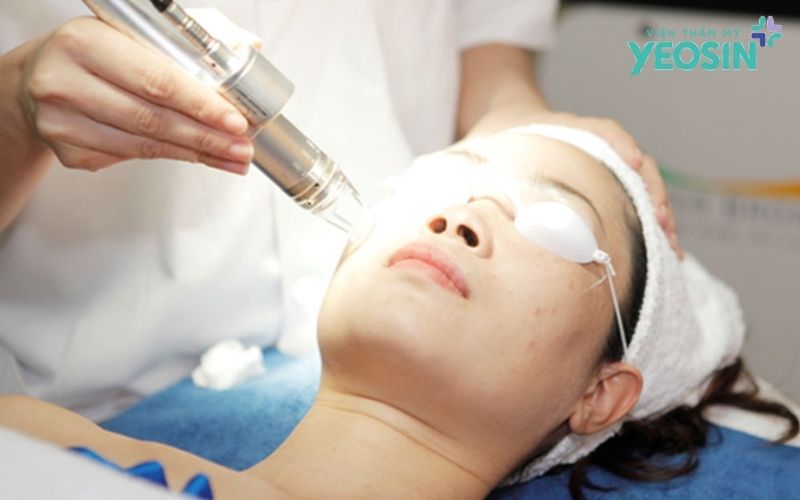 Công nghệ Filling Scars là gì?