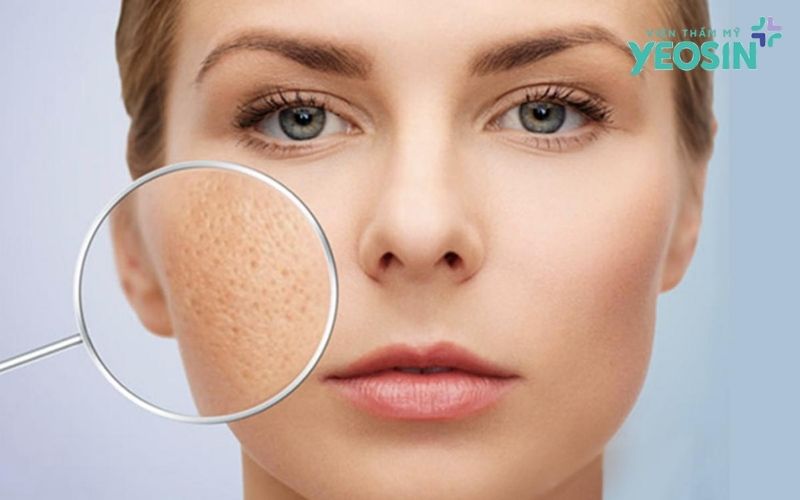 Quy trình điều trị sẹo rỗ bằng công nghệ Filling Scars tại Yeosin