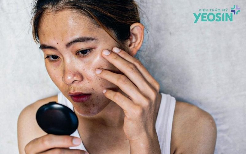 Nám Da Sau Sinh Có Tự Hết Không? Cách Cải Thiện An Toàn Và Hiệu Quả