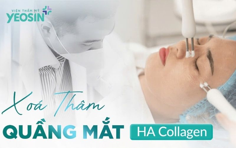 Phương pháp trị thâm quầng mắt công nghệ cao an toàn và hiệu quả