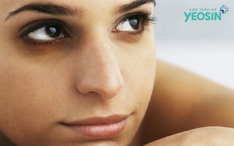 Xóa thâm quầng mắt giá bao nhiêu?