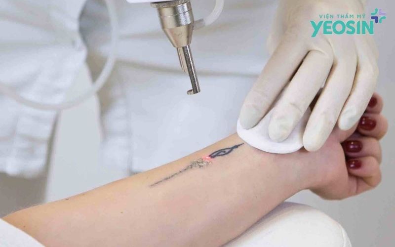 Xóa xăm có đau không?