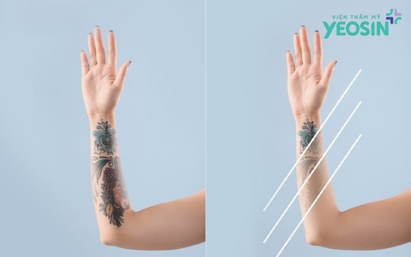 Cần bao nhiêu lần để xóa xăm hoàn toàn?