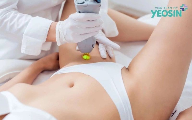 Triệt Lông Bikini Là Gì? Những Điều Bạn Cần Biết 14 anh Yeosin 5 2