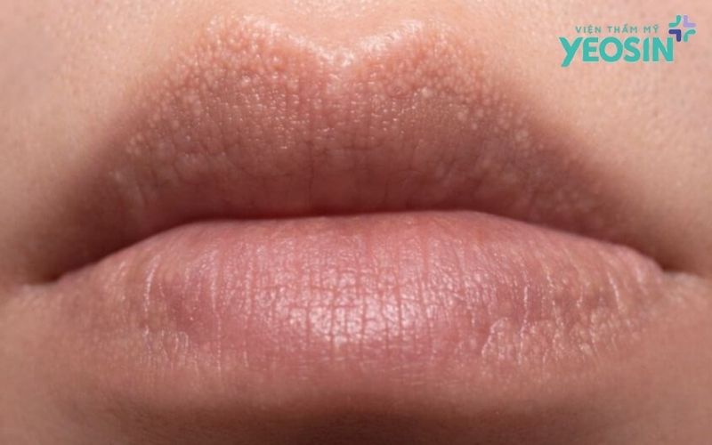 Đốt hạt Fordyce tại Yeosin - Giải pháp cải thiện đốm trắng trên môi bằng công nghệ Plasma 8 Hạt Fordyce Là Gì?