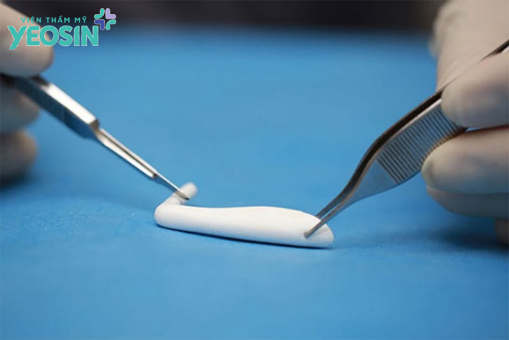 Sụn nâng mũi là gì?