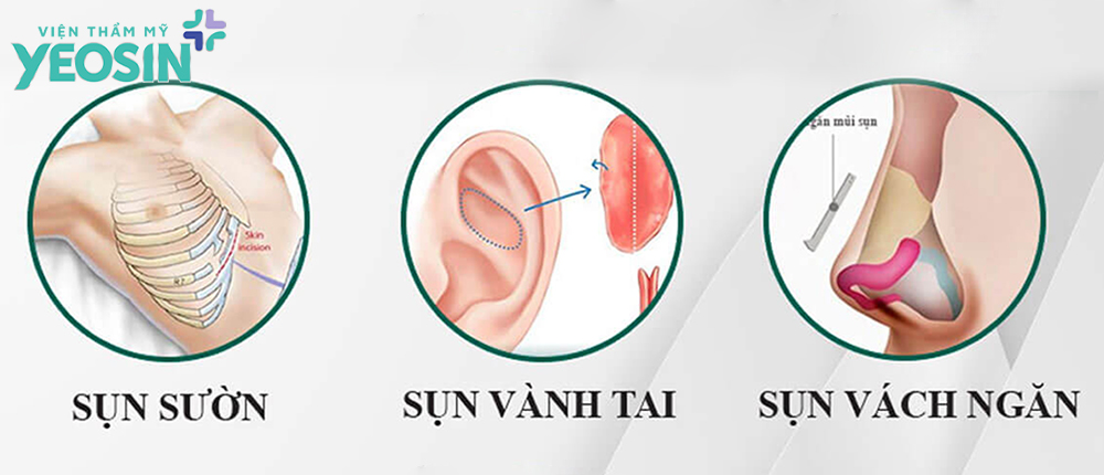 Các loại sụn nâng mũi tự thân