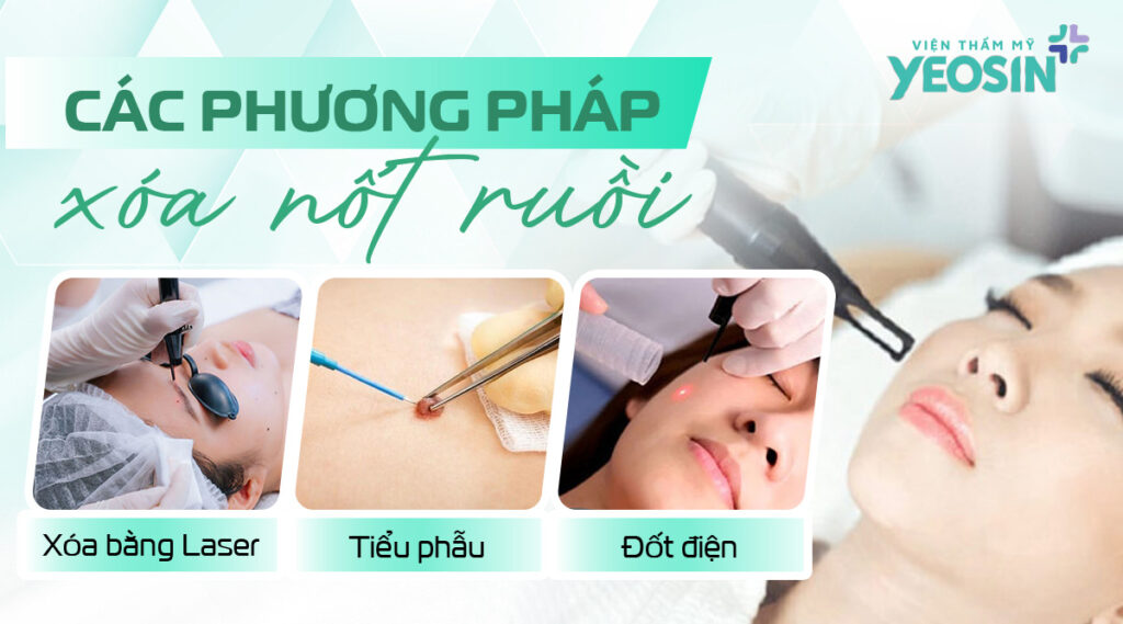 Góc giải đáp: Tẩy nốt ruồi có đau không, có sẹo không? 8 Chi tiết mức độ đau của từng phương pháp xóa nốt ruồi