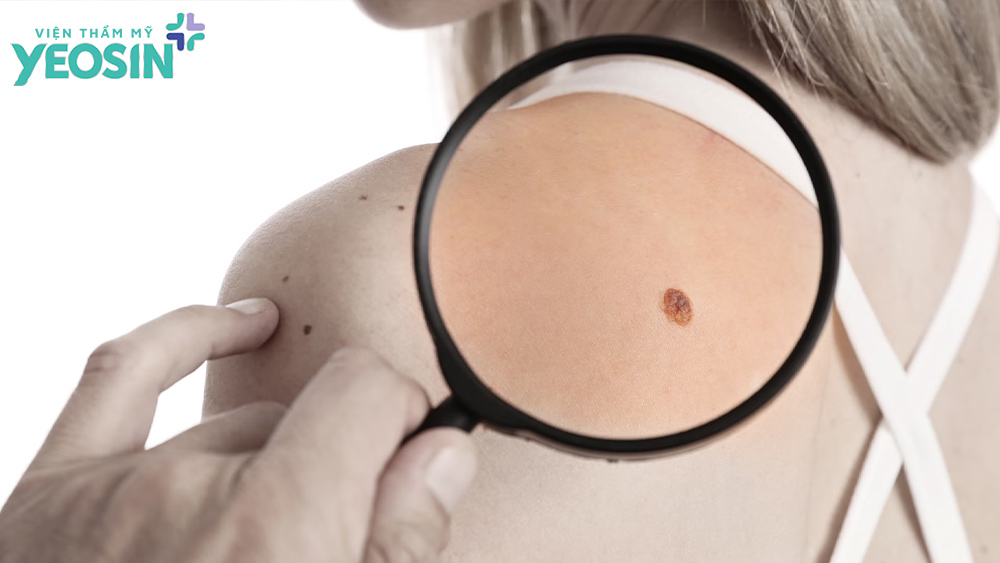 Những lưu ý trước và sau khi tẩy mụn ruồi bạn cần biết